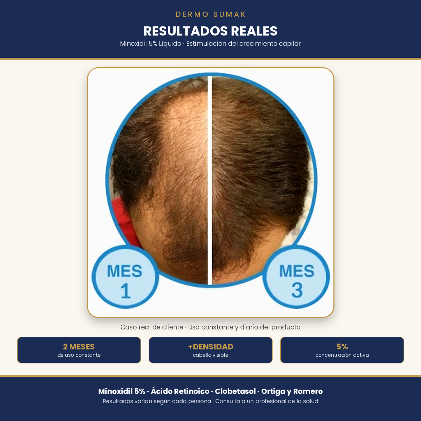 MINOXIDIL 5% EN LIQUIDO 120ML DERMOSUMAK