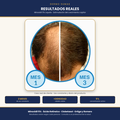 MINOXIDIL 5% EN LIQUIDO 120ML DERMOSUMAK